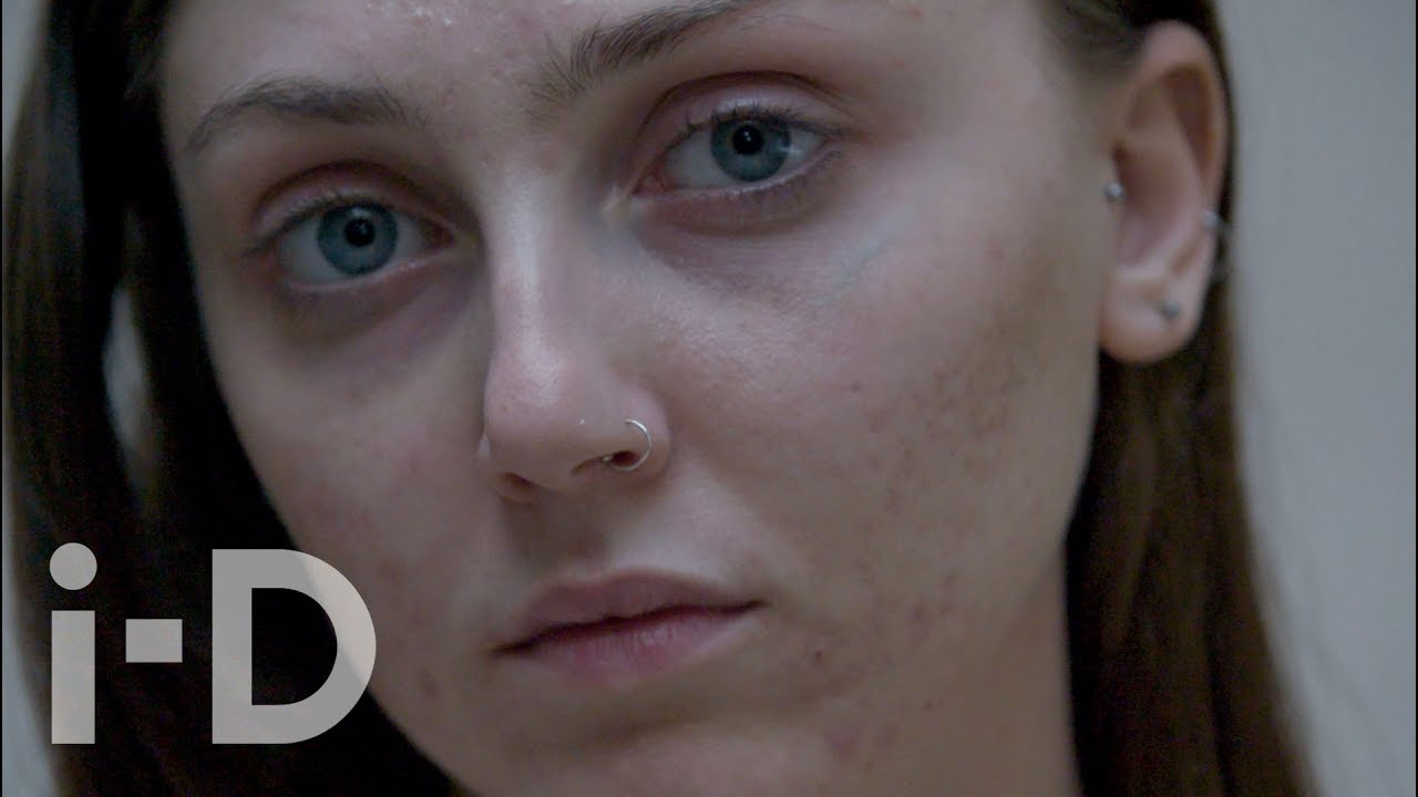 Is Acne the Final Frontier of Body Positivity? | i-D