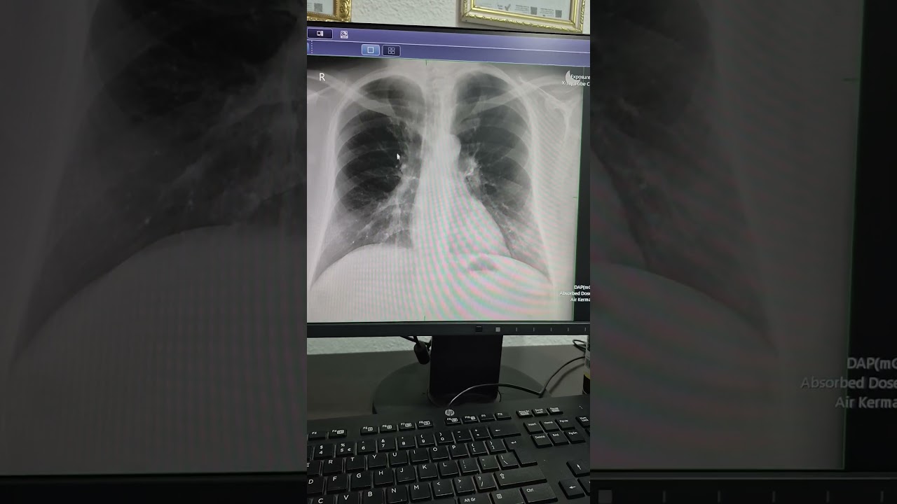 Our chest x-ray with the heart shadow 