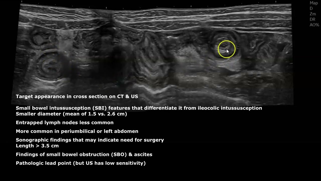 Small Bowel Intussusception