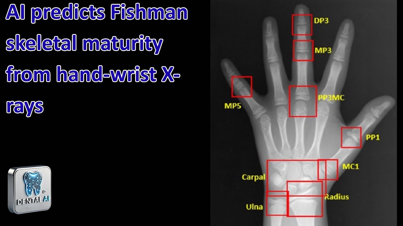 AI predicts Fishman skeletal maturity from hand wrist X rays