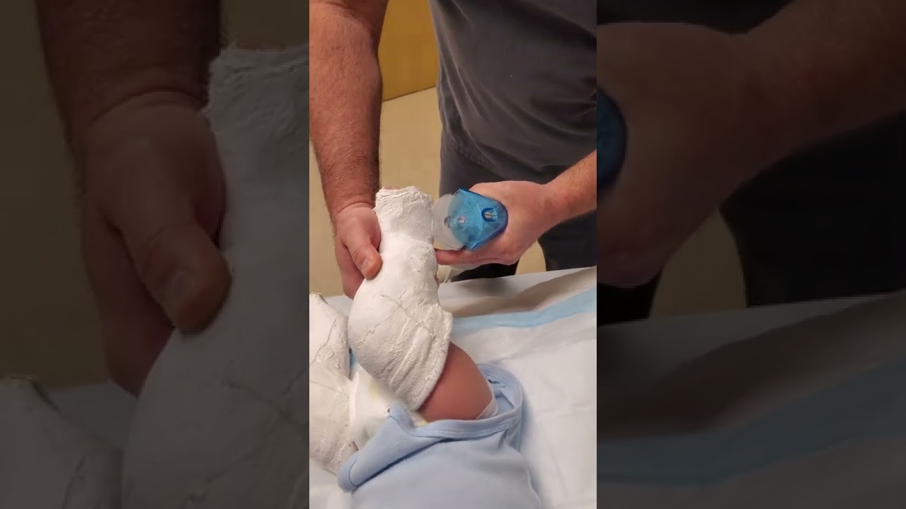 Снятие гипсового гипса при косолапости