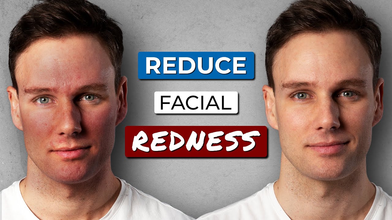 How to GET RID OF REDNESS on your FACE!!