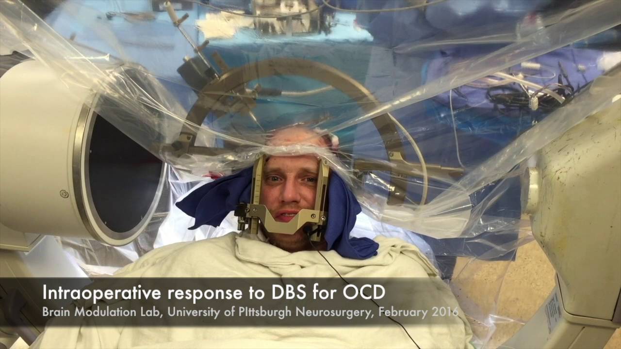 Ventral Striatum/Anterior Capsule Stimulation During Intraoperative&nbsp;DBS for OCD.