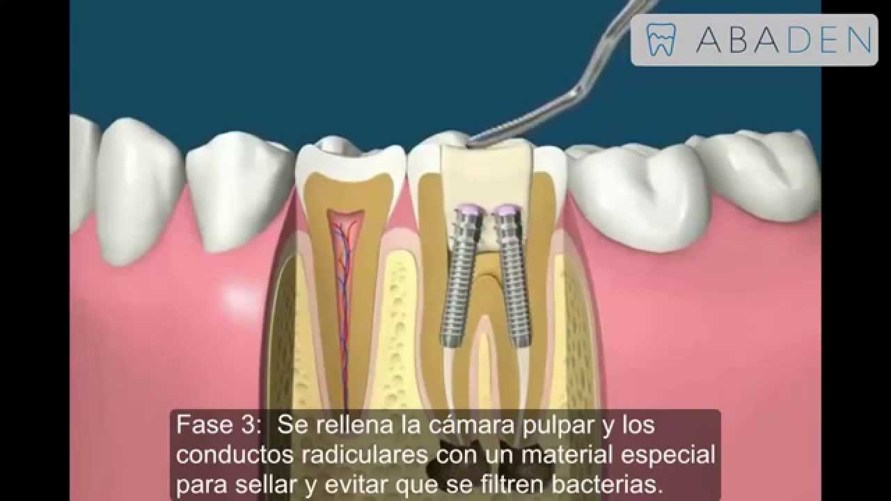 Endodoncia - Tratamiento para matar el nervio del diente - Abaden Dentistas