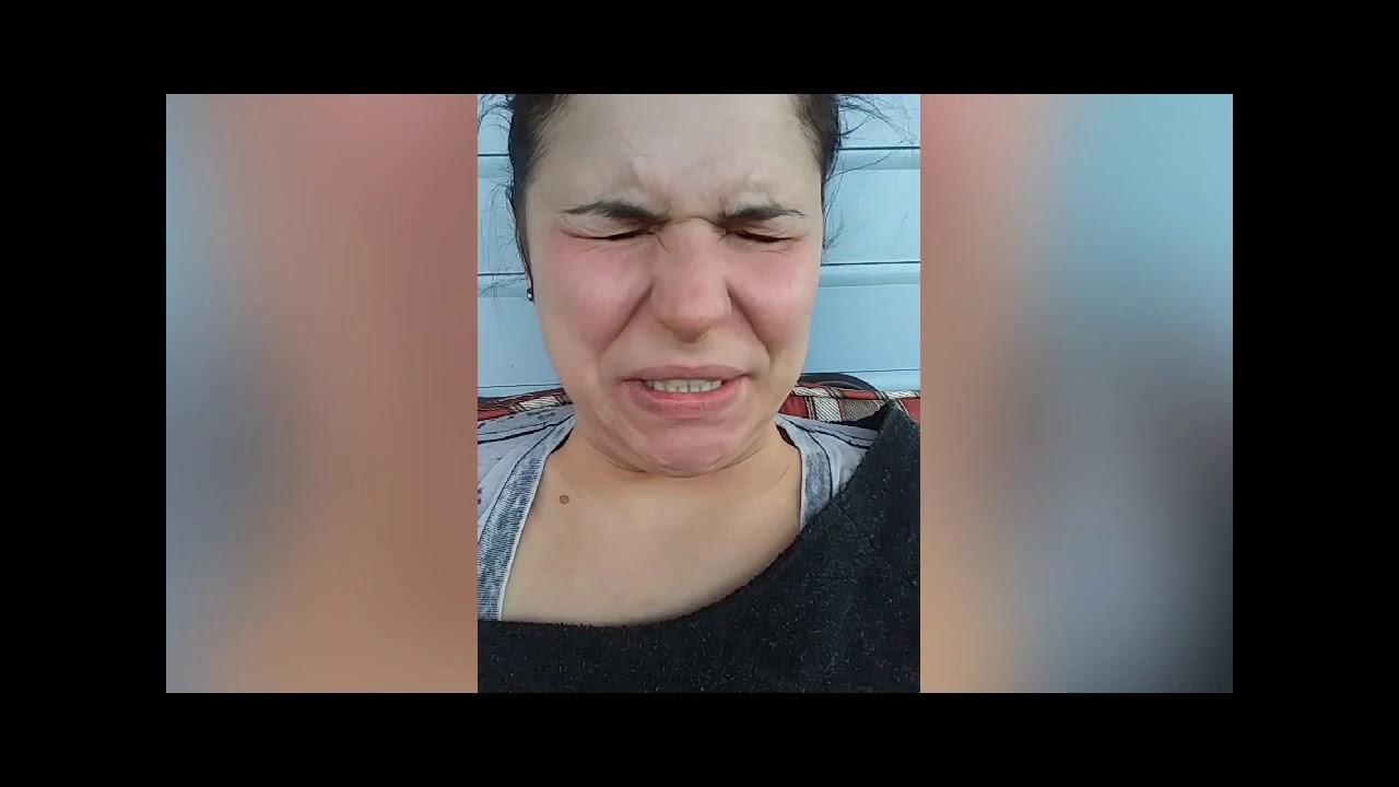 Tardive Dyskinesia and what it can look like early on