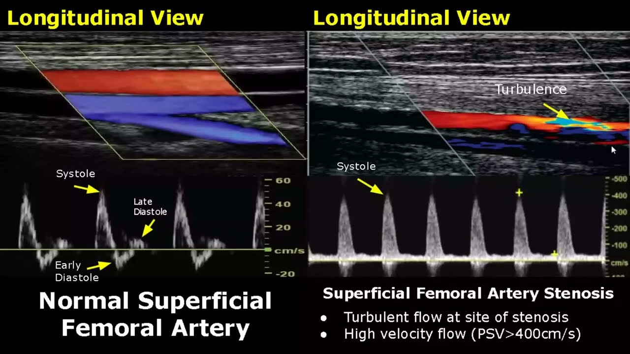 Femoral Artery Doppler Ultrasound Normal Vs Abnormal | Stenosis/Occlusion/Pseudoaneurysm/AVF USG