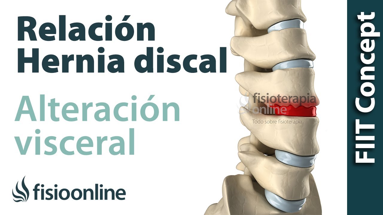 &iquest;C&oacute;mo se produce una hernia discal por una disfunci&oacute;n o alteraci&oacute;n visceral?