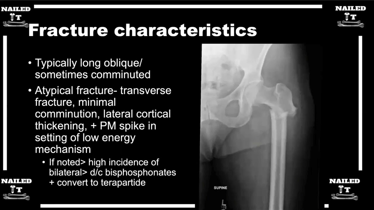 subtrochanteric Femur Fractures w/ Dr. Araiza