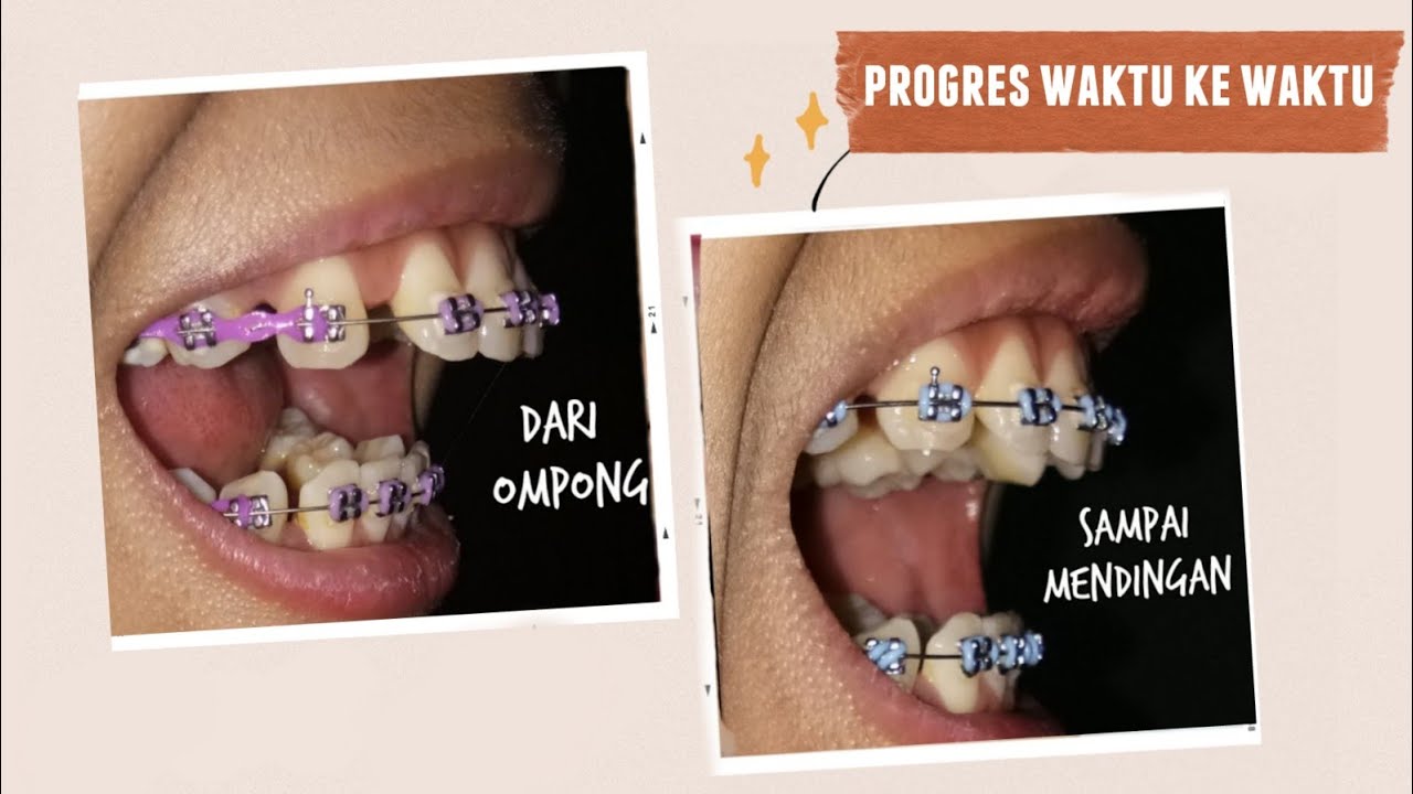 Progress Gigi Saat Pakai Behel 1 tahun #3