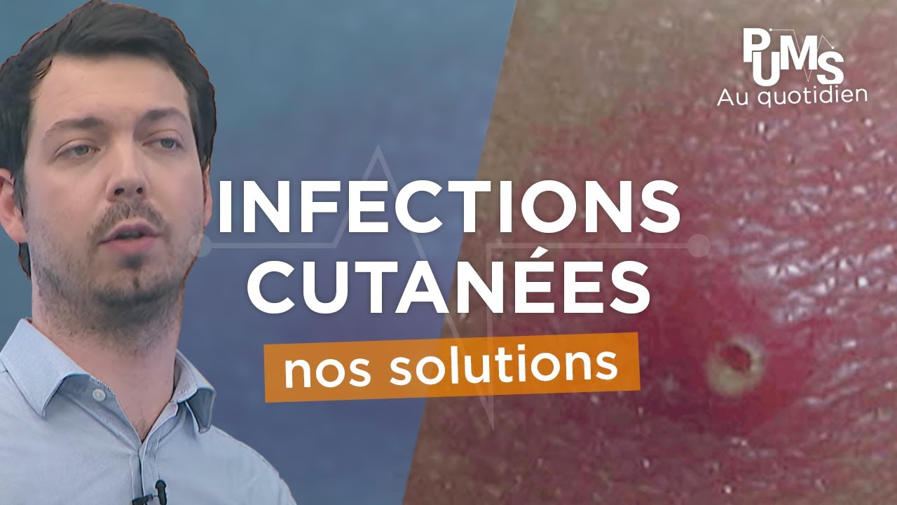 Signes SUR VOTRE PEAU qui témoignent d'une INFECTION SÉVÈRE (+ conseils pour se soigner sans risque)