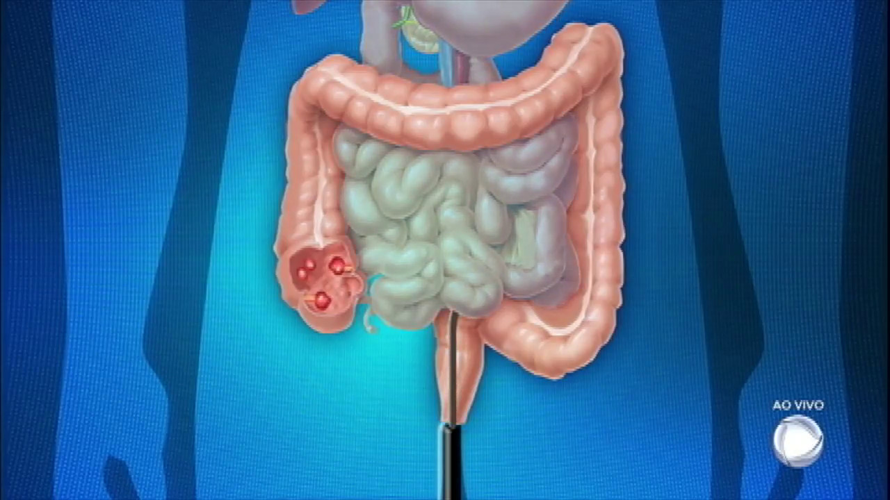 Você e o Doutor: saiba tudo sobre os males do intestino