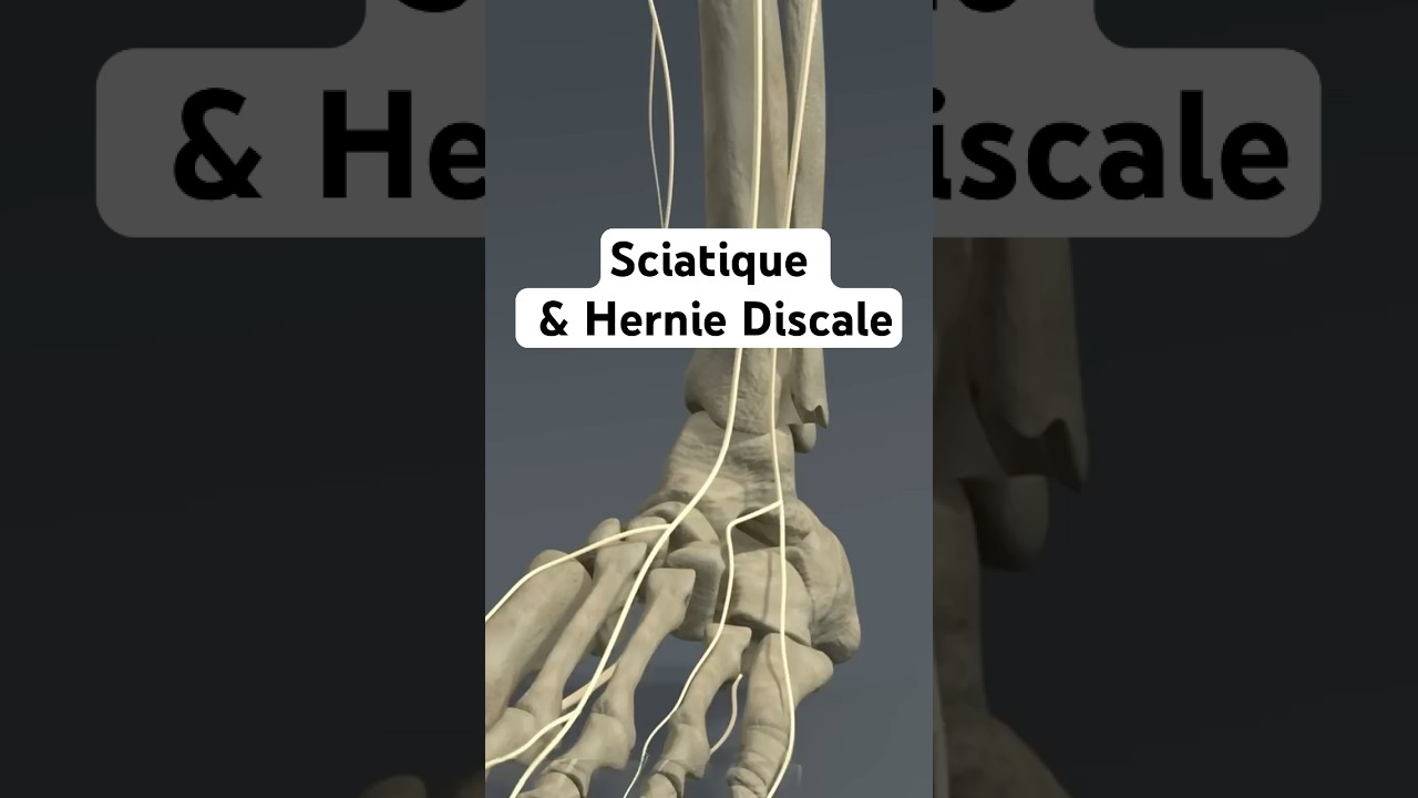 Sciatique & Hernie Discale #maldedos #lombaire #sciatique #herniediscale
