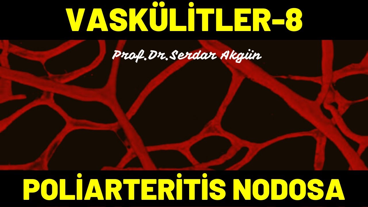 Vaskülitler, 8, Poliarteritis Nodosa, Romatoloji, Tıp Dersleri, Serdar Akgün