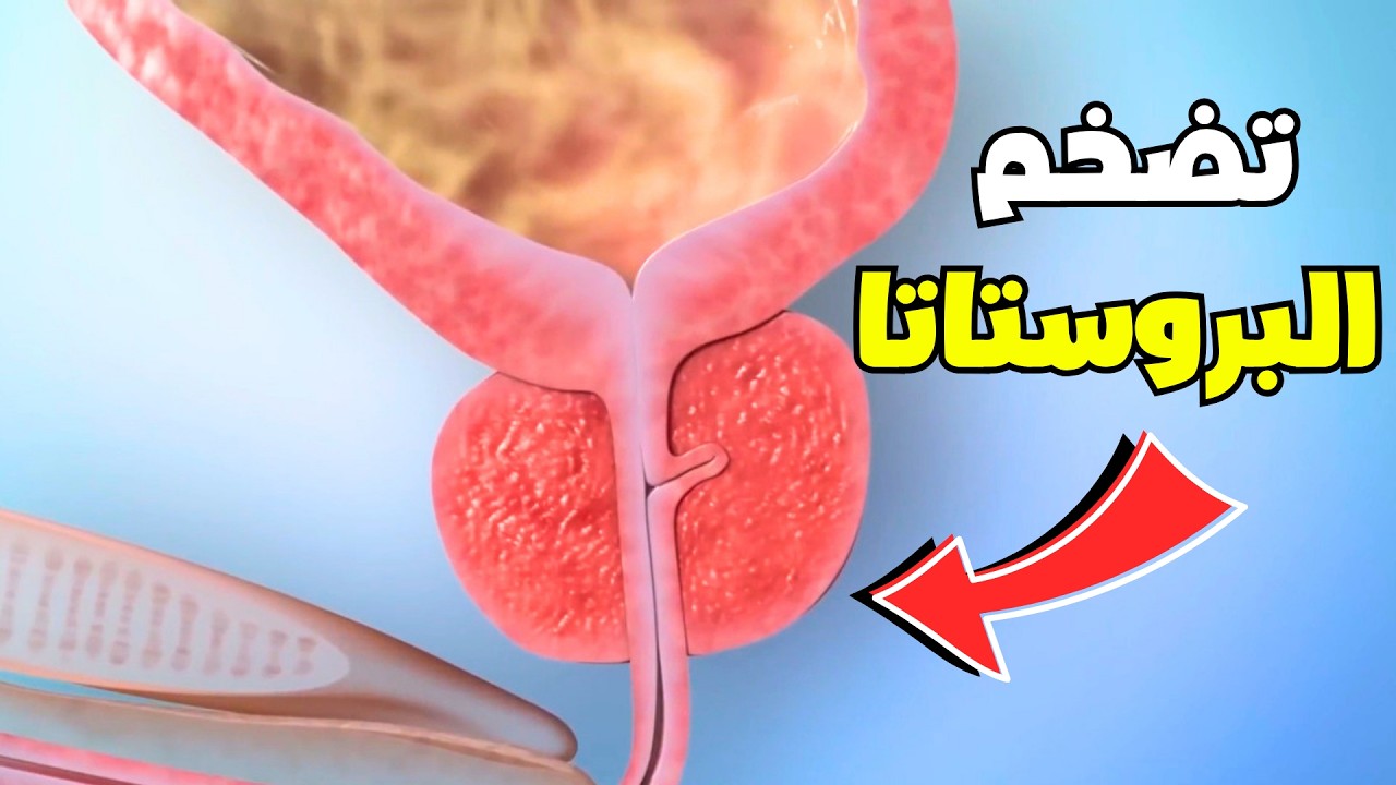 شاهد كيف يتم ازاله سرطان البروستاتا للرجال_Prostate cancer removal process