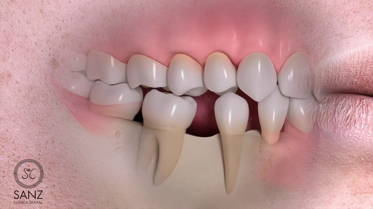 Deterioro de hueso maxilar por falta de piezas dentales