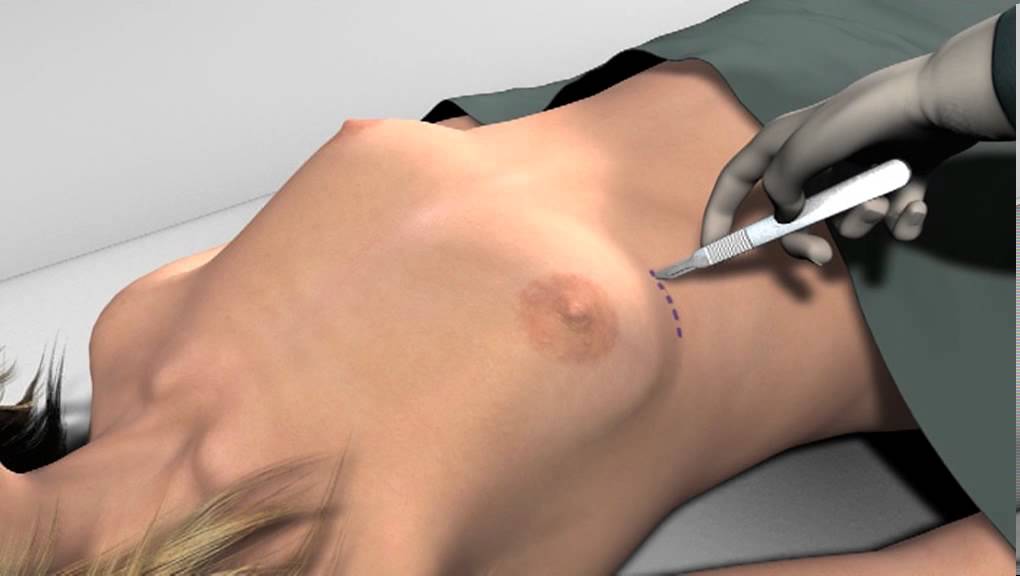 3-D animatie: Borstvergroting