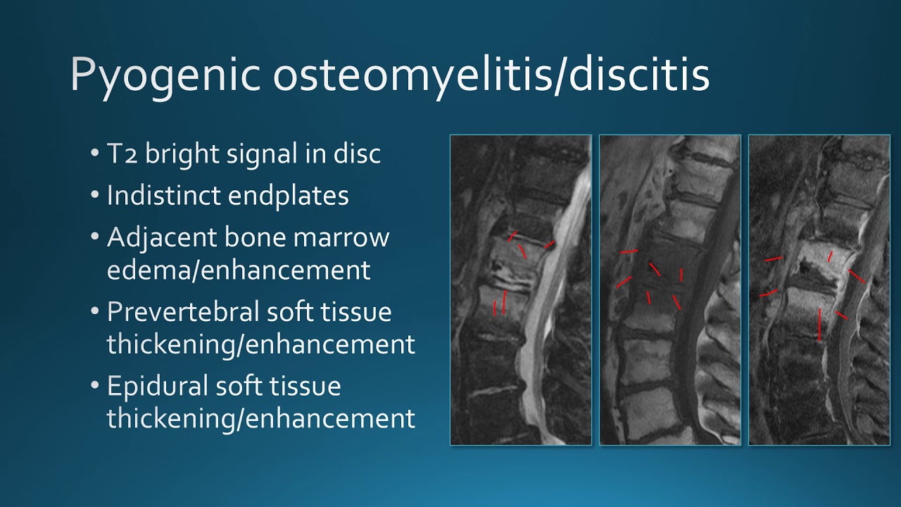 Extradural spinal infection