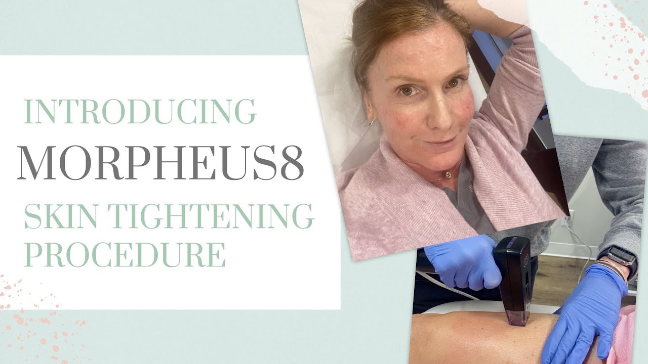 Introducing the Morpheus8 Skin Tightening Procedure! | Empowering Midlife Wellness