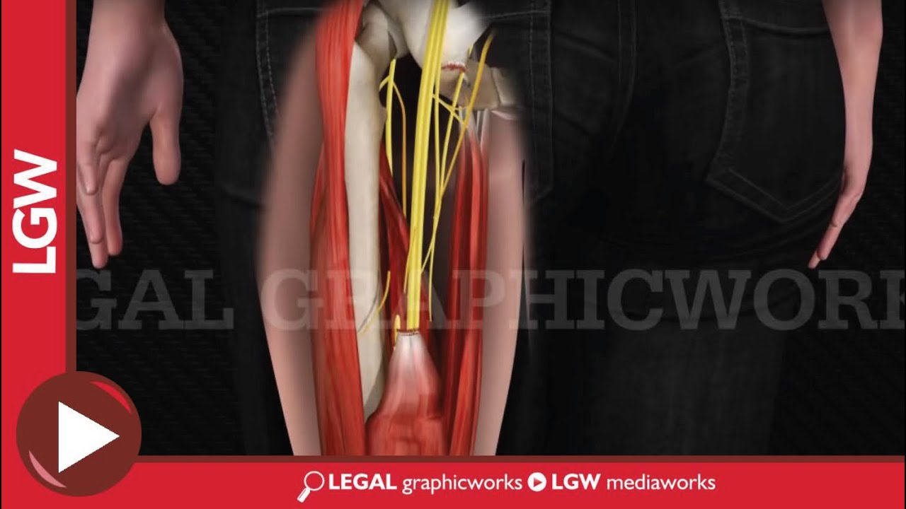 Hamstring Repair Surgery 3D animation