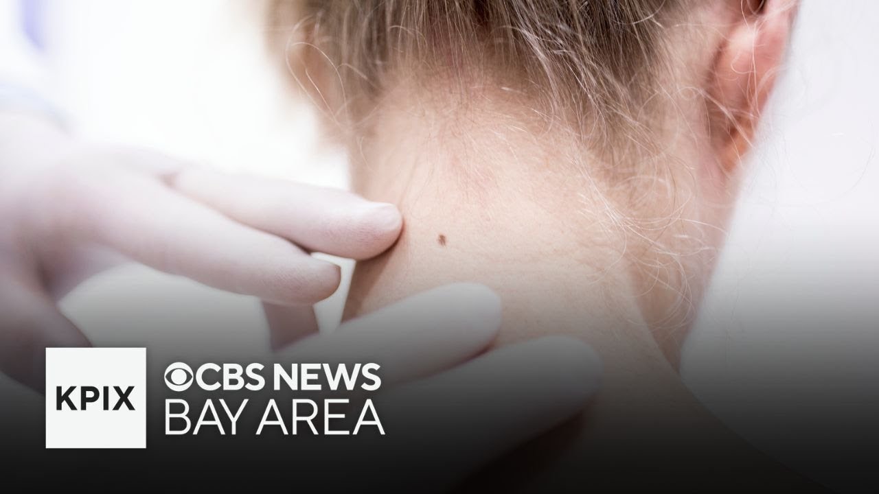Stanford treats first U.S. cancer patient using breakthrough treatment for melanoma