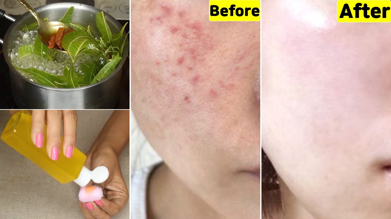 In 3 Uses👆🏼this toner cleared my acne, whiteheads, pigmentation & oily skin-Get clear skin in 3 Days
