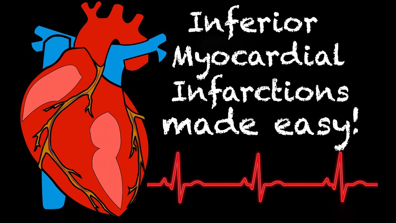 EMS Cardiology || Tachy Tuesday: Inferior Myocardial Infarction (STEMI)