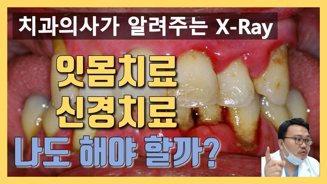 치과 엑스레이 보는법. 치과 가기전에 꼭 보고 가세요. (잇몸치료, 신경치료)