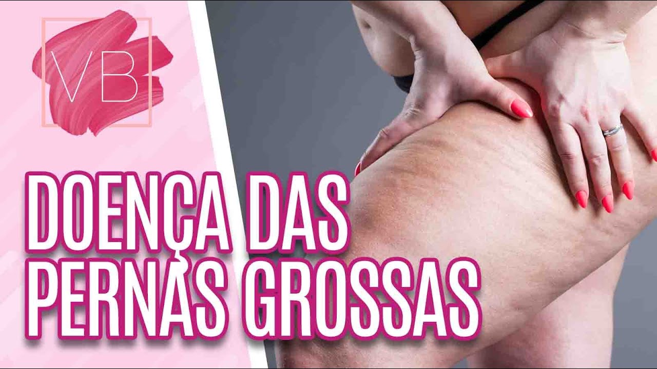 Causas e sintomas da Lipedema, doença das pernas grossas - Você Bonita (04/03/21)