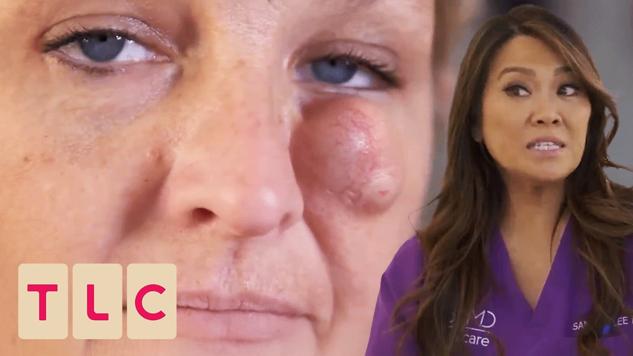 Dr. Lee Removes Cyst Which Has Blocked Patient's Vision | Dr. Pimple Popper