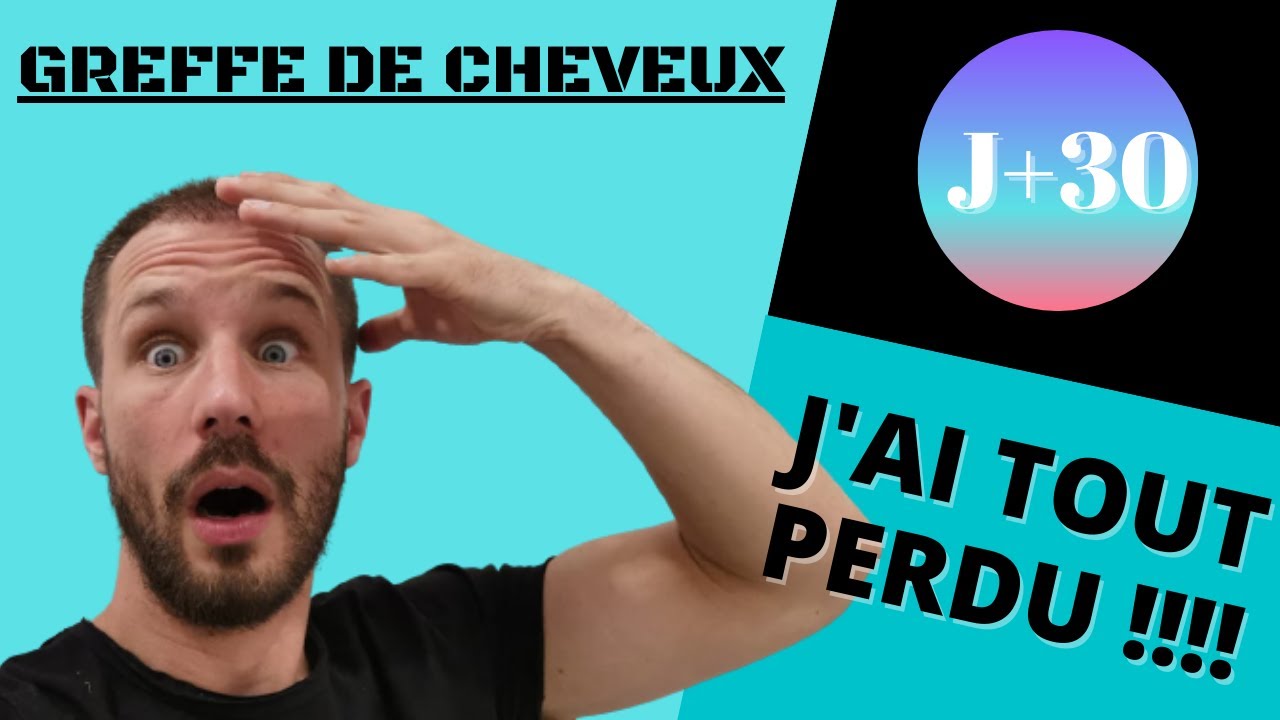 GREFFE de CHEVEUX J+30 Bouton, rougeurs et perte de cheveux !!!
