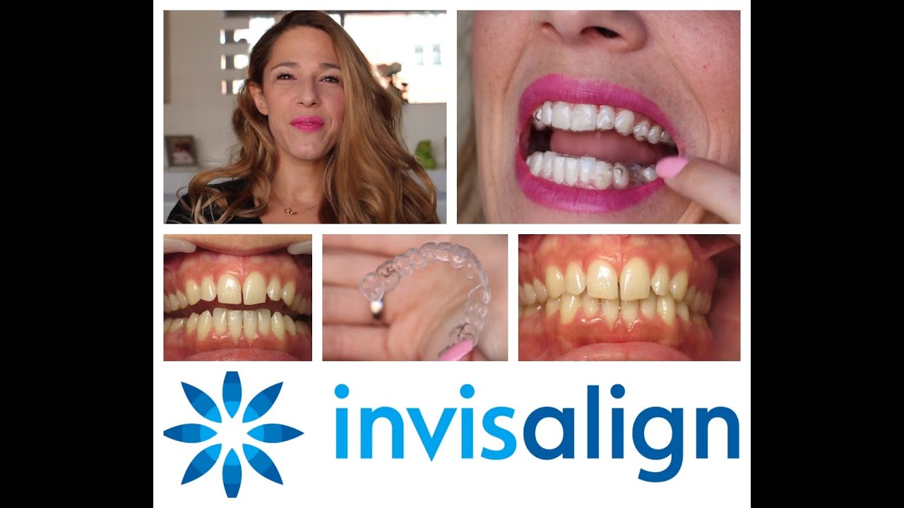Départ pour un nouveau sourire avec INVISALIGN (découvrez l'évolution future de mes dents !)