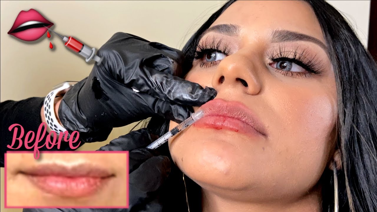 Getting Lip Fillers for the FIRST Time + Healing Process VLOG ft. Restylane | JANIE SALAZAR