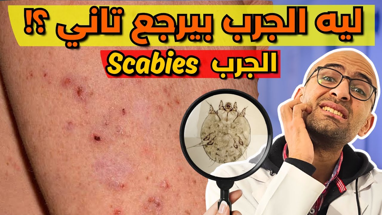 علاج الجرب النهائي (بالتفاصيل) - وليه بيرجع تاني؟!