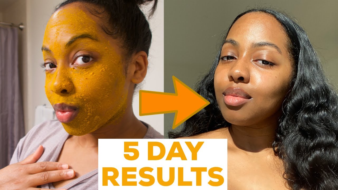 I DID A 5 DAY TURMERIC FACE MASK & This Happened!! || MISS C Beauty