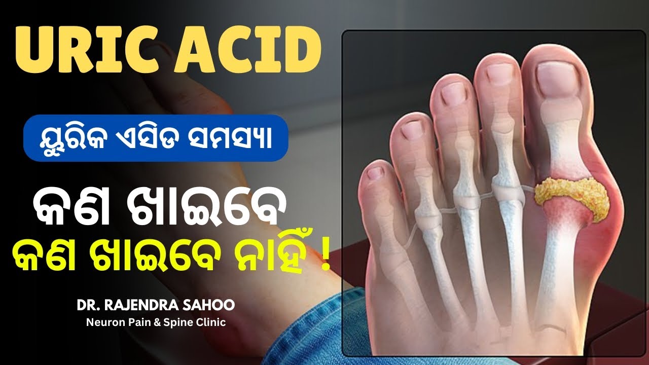 Uric Acid Diet Plan | Top Foods to Control #UricAcid Naturally ୟୁରିକ ଏସିଡ କଣ ଖାଇବେ, କଣ ଖାଇବେ ନାହିଁ !