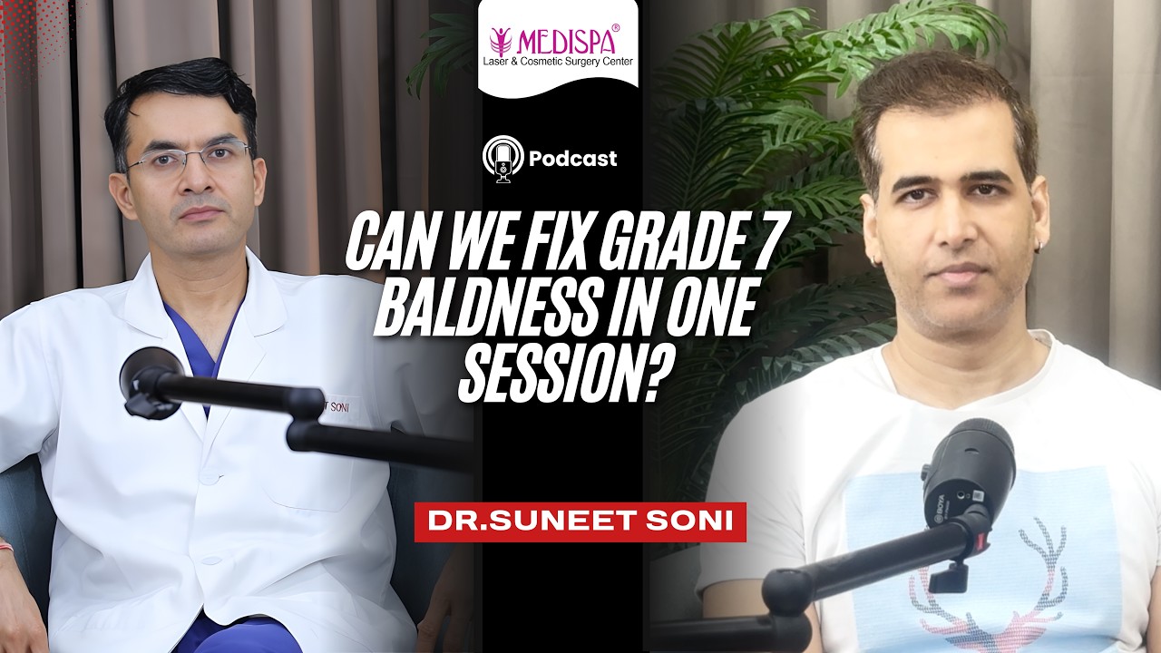 5000 Grafts Grade 7 Baldness covered in one session check out Hair Transplant Results by Dr Suneet
