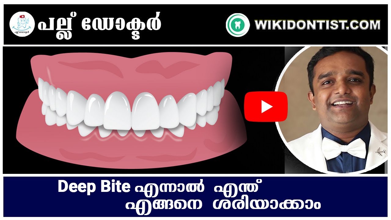 palu doctor Deep Bite.#dentallife #deepbite #dentist #smile #teeth #dentalhygienist #dentalcare