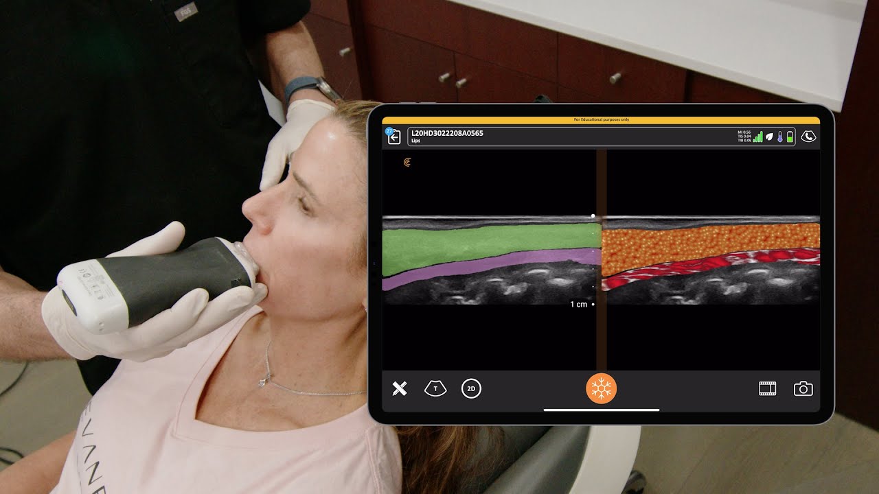 Ultrasound Evaluation of the Lips