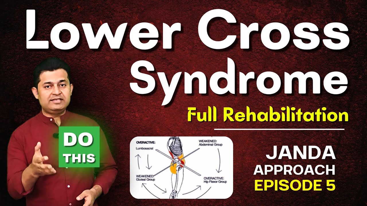 Lower Cross Syndrome (LCS) – Complete Treatment & Rehab Protocol.