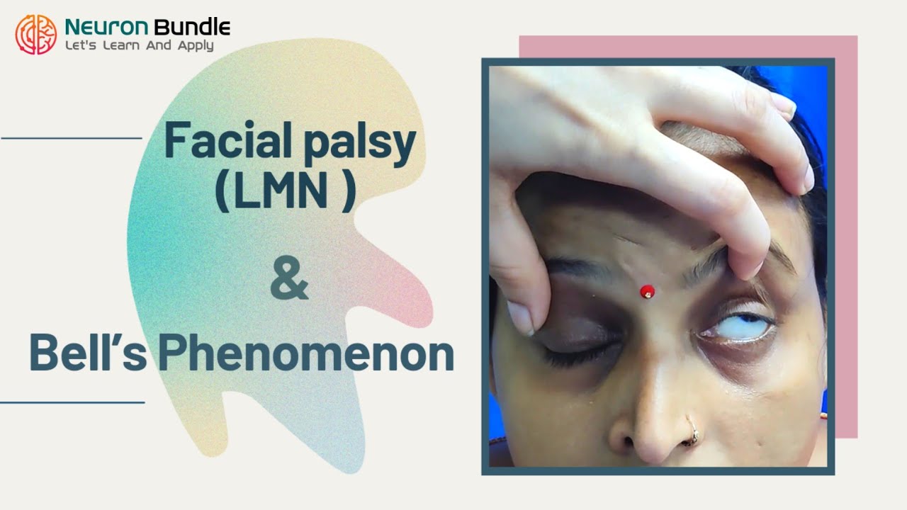Bell&rsquo;s Phenomenon & LMN  Facial /Bell&rsquo;s Palsy : Clinical features #LMNvsUMN #cranialnerveexam