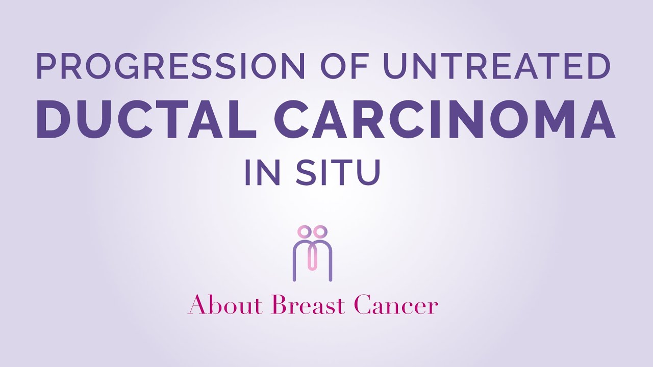 Progression of Ductal Carcinoma in Situ