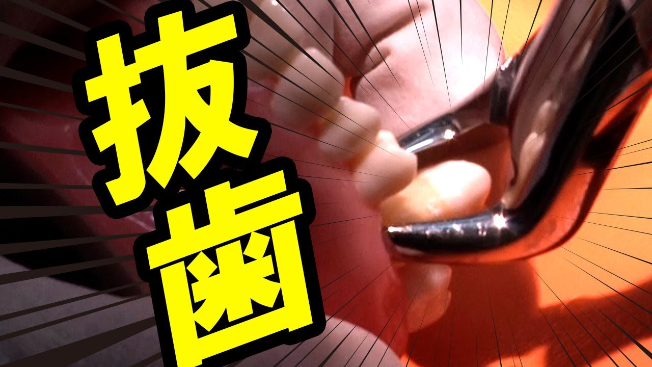 怖い！奥歯の抜歯はこうやって抜いてます！