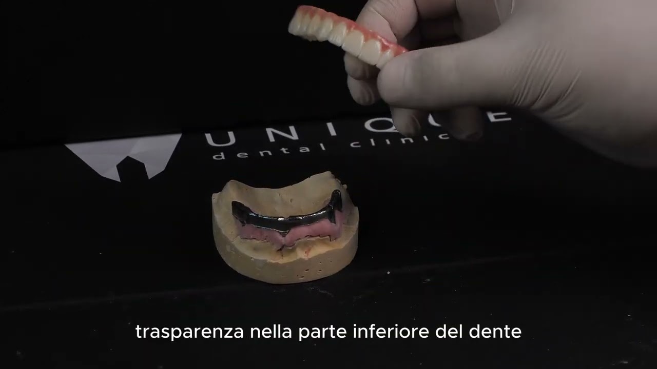All on 4 con Barra in Titanio e Denti in Zirconia Multilayer | Lavoro di Alta Precisione