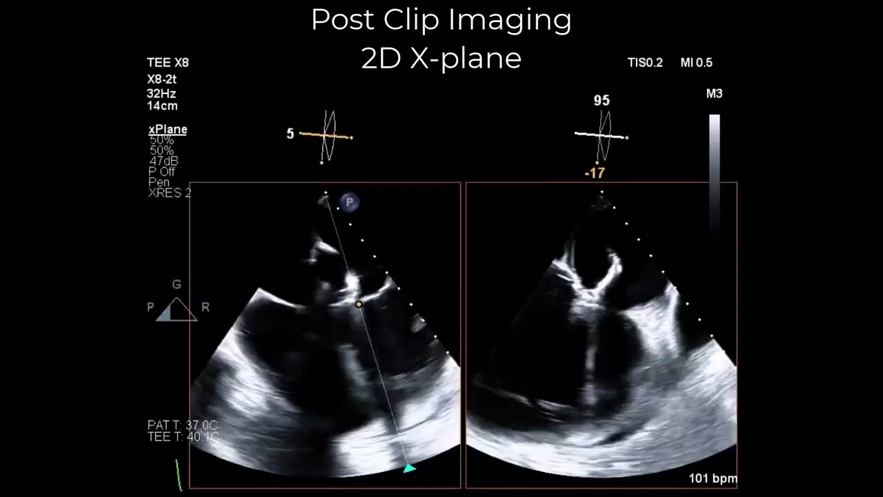 Intraprocedural Echo Imaging of TEER in Complete AV Canal Left Atrioventricular Valve (Case 3)