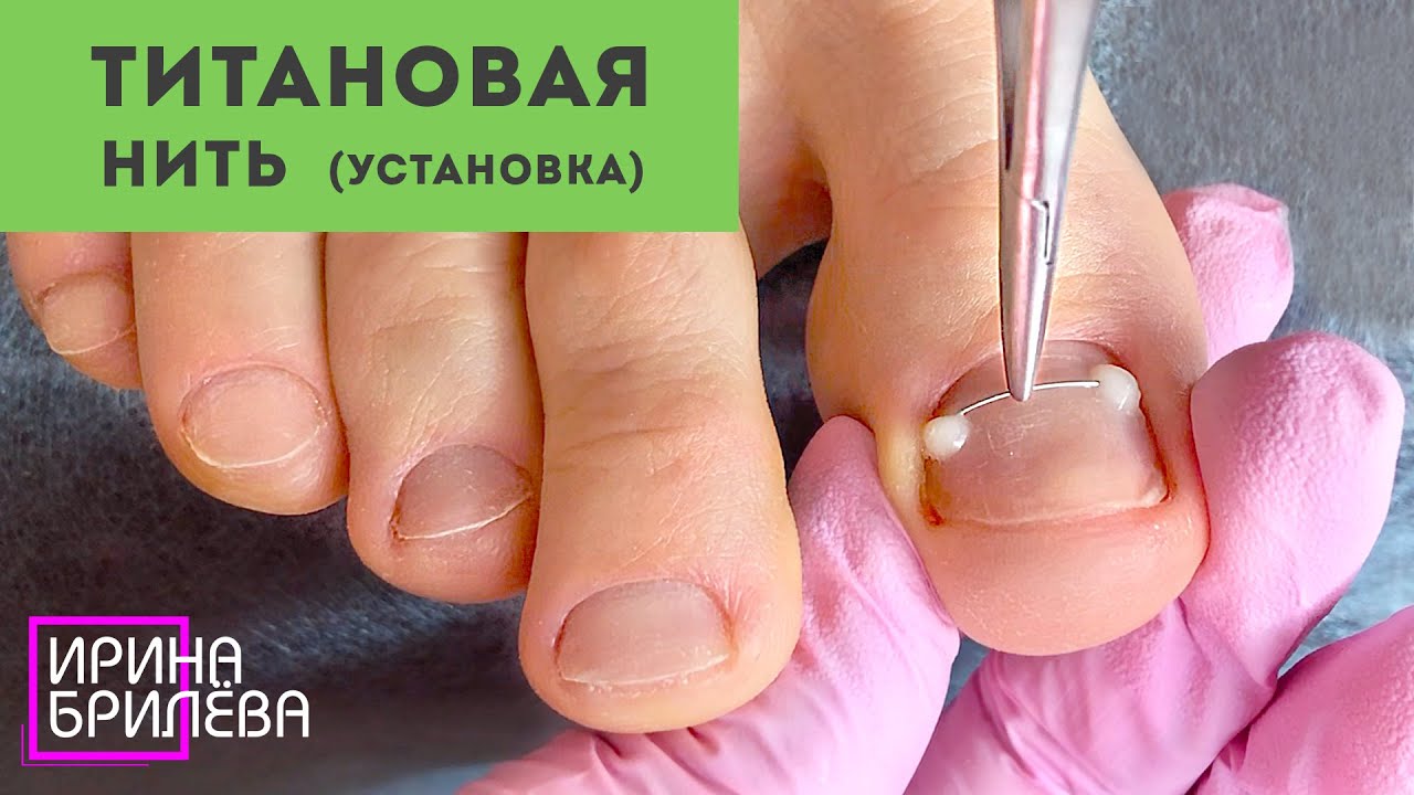 Установка ТИТАНОВОЙ НИТИ (NiTi) 🌸 Педикюр (убираем подногтевые мозоли) 🌸 Ирина Брилёва
