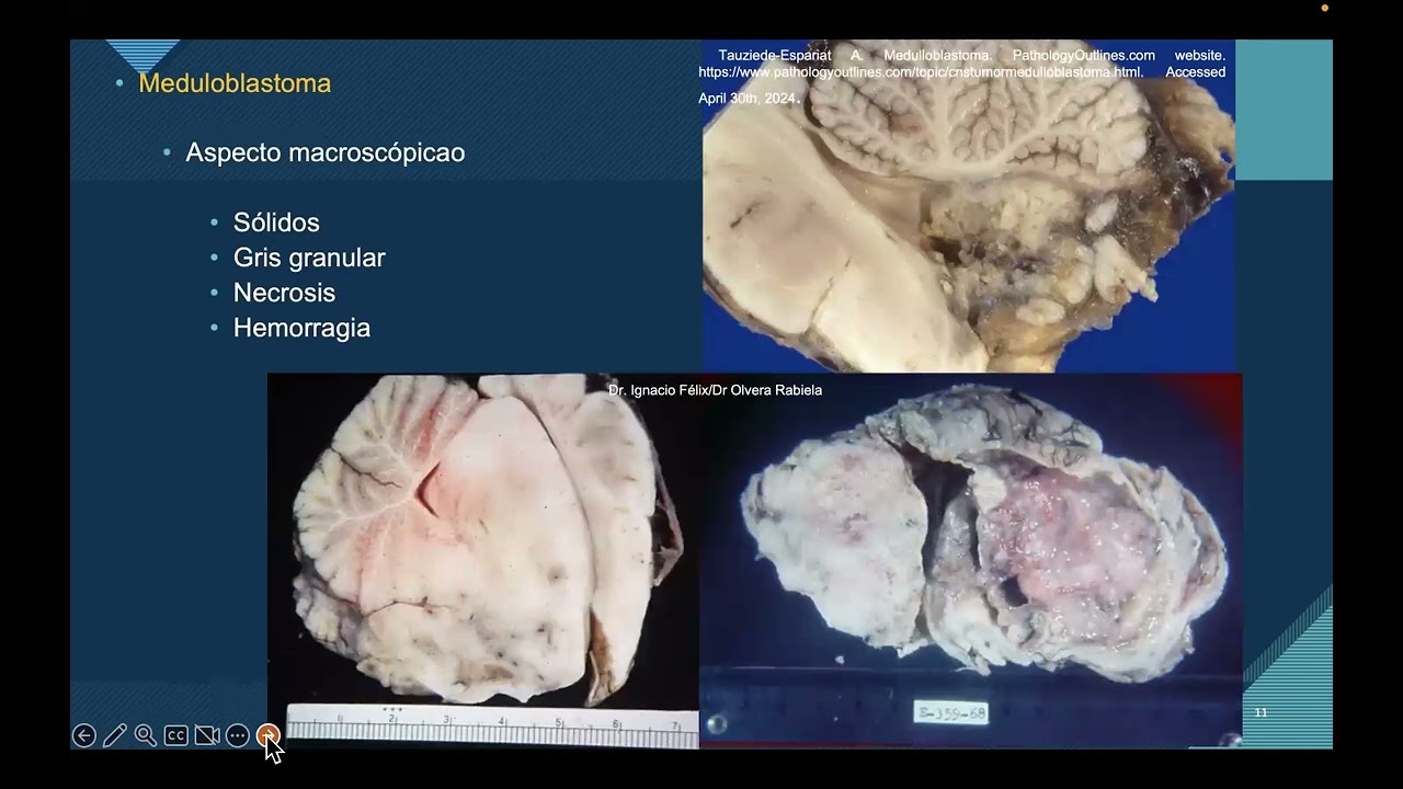 Neuropatologia: Meduloblastoma.