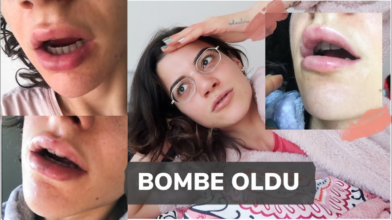 dudak dolgusu dudaklarımı mahvetti