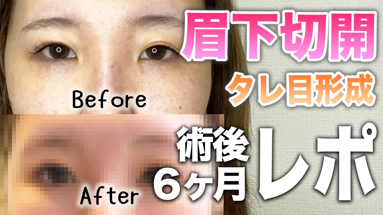 【整形後半年レポ】眉下切開・目尻切開・タレ目形成のその後は？！【ビフォアフ有】