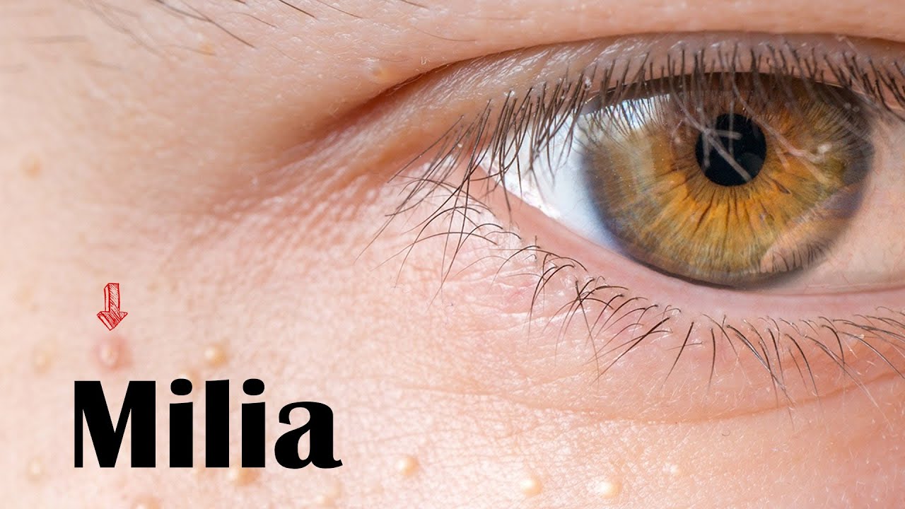 Milia - Types, Causes, And Treatment