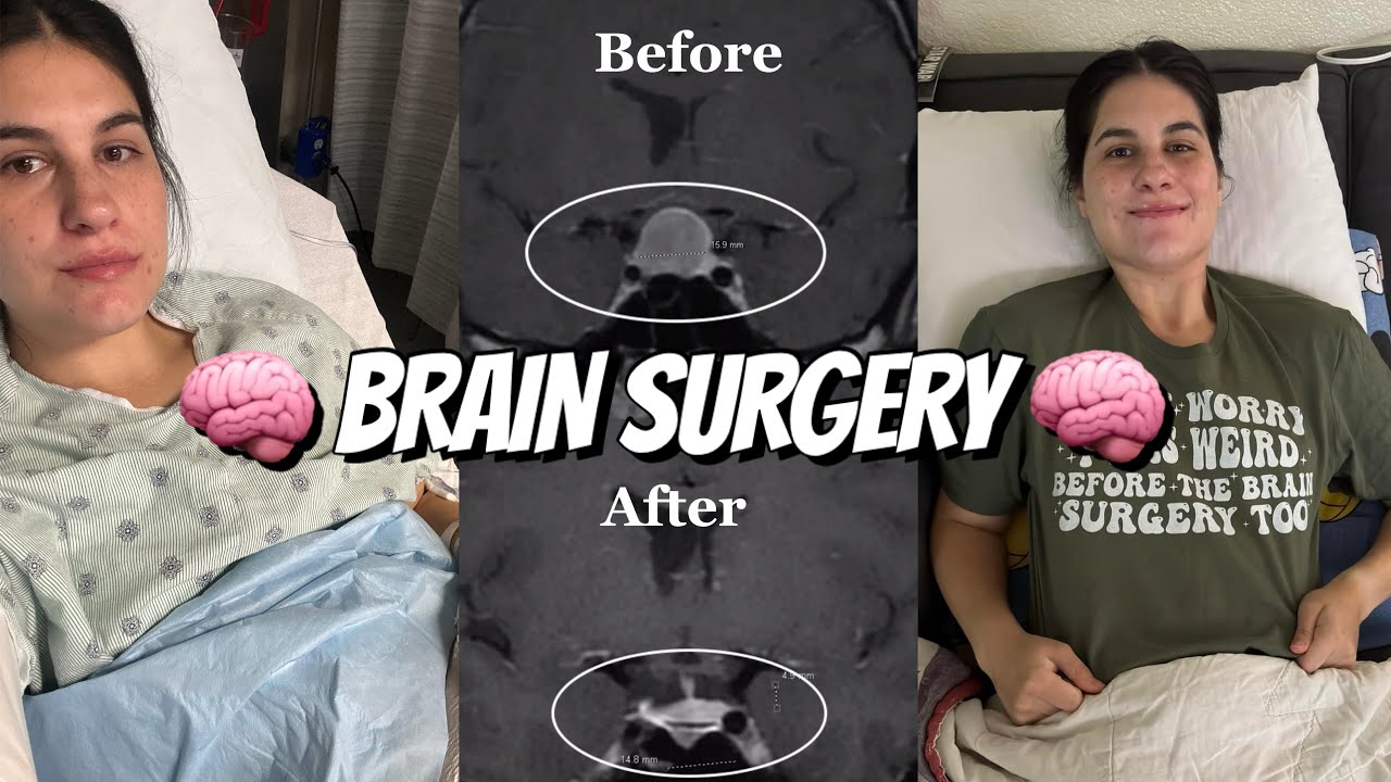 I Got Diagnosed With A Brain Tumor, Here's My Story! Pituitary Adenoma Surgery Documentary